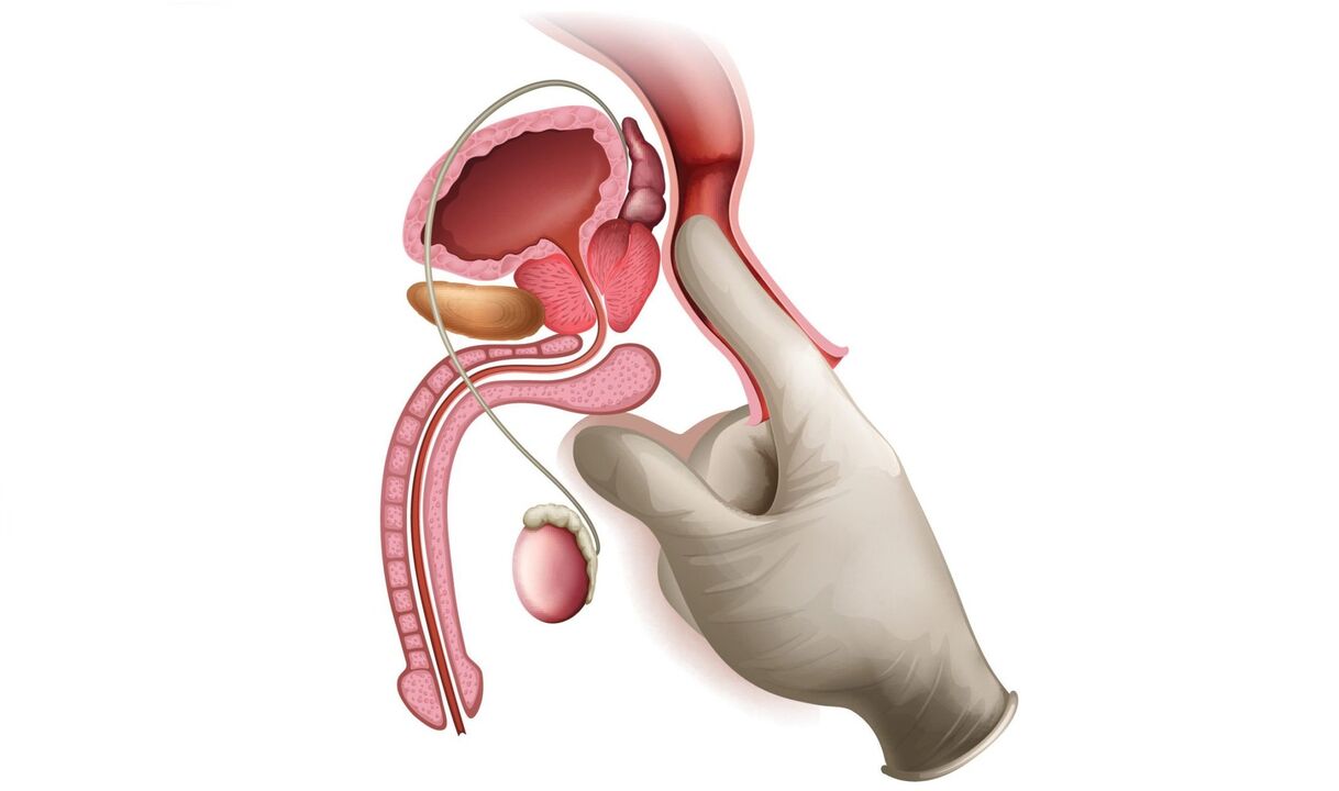 Prostatit için prostat masajı