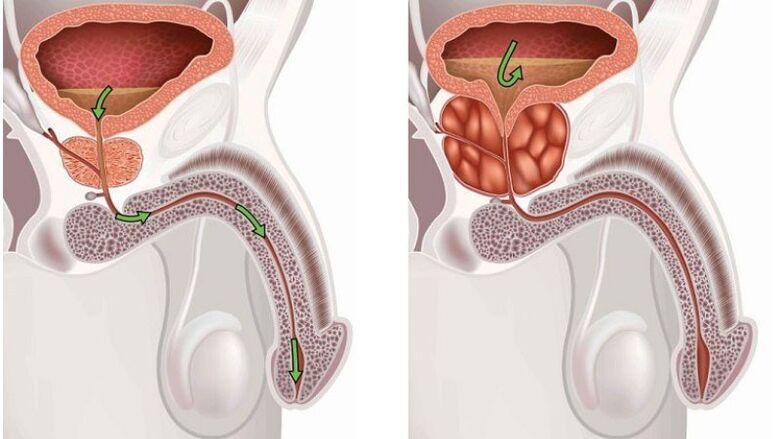 sağlıklı ve iltihaplı prostat bezi ile prostatit