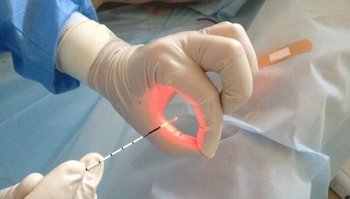 prostatit için lazer tedavisi